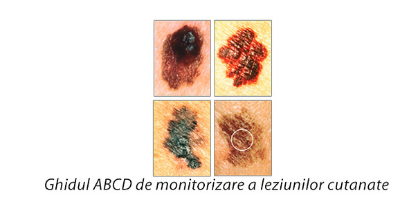 Ghidul ABCD de monitorizare a leziunilor cutanate